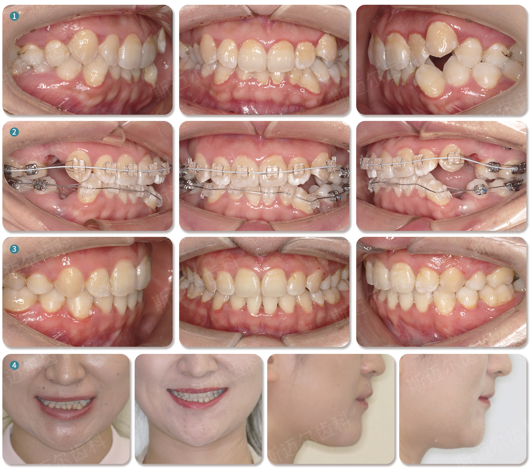 南宁牙齿矫正 | 美学正畸之笑容设计——虎牙外突矫正 - 知乎