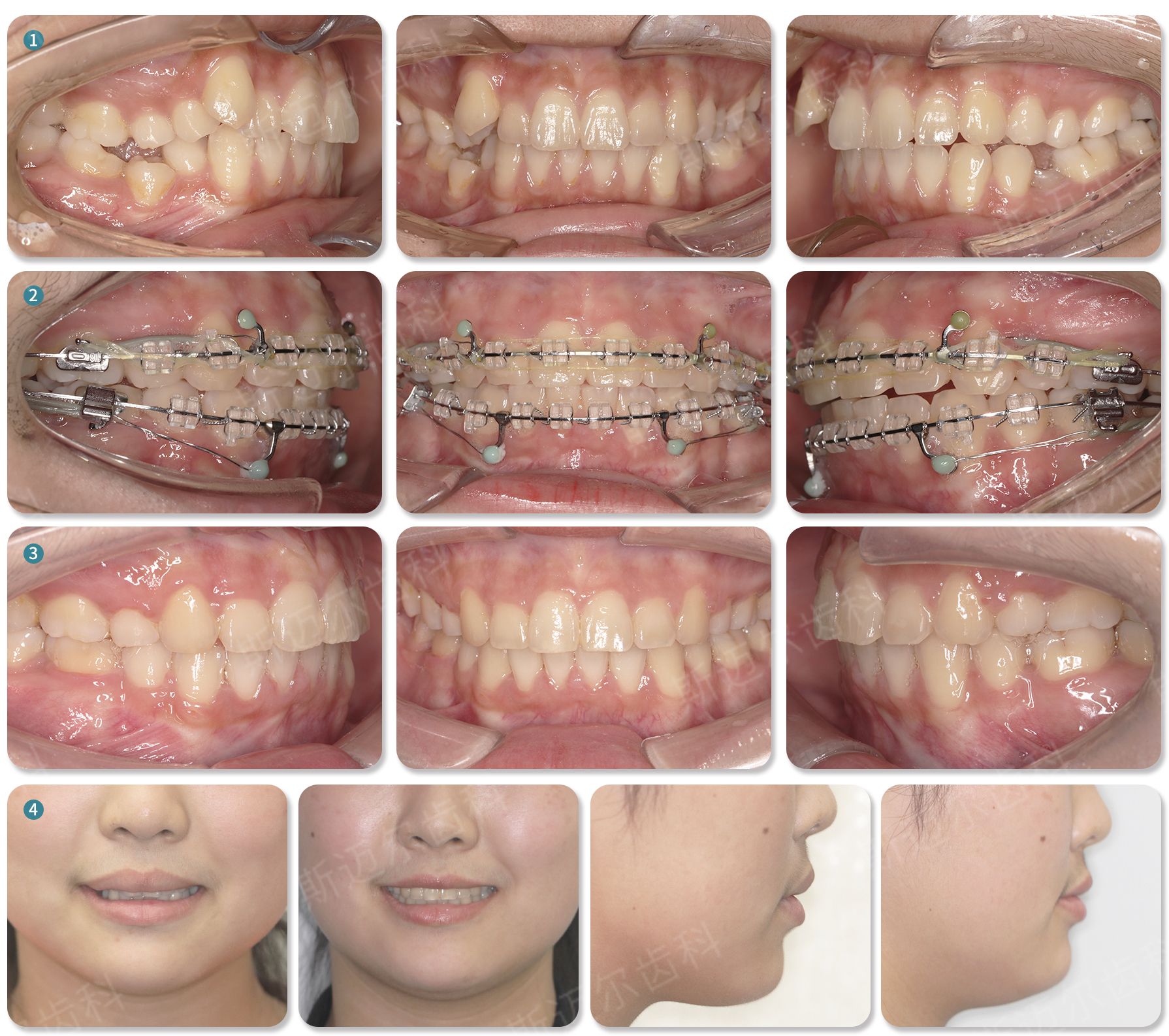 虎牙正畸案例分享 | 斯迈尔齿科_斯迈尔齿科(SME)官方网站 - 一次选择 终身相伴
