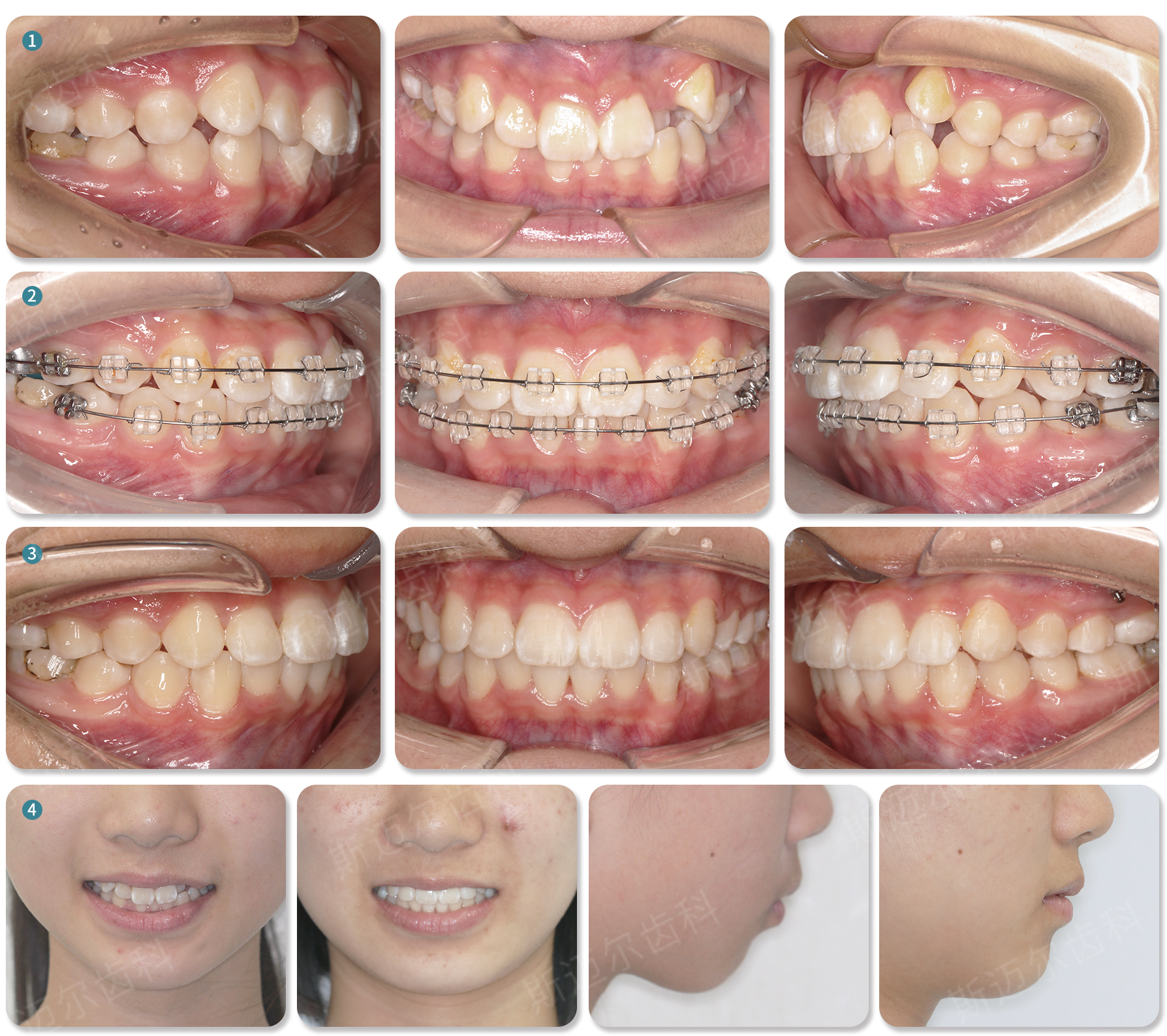 白色牙齿贴舌的微笑妇女的部分看法灰色隔离牙齿美白口腔牙齿口腔牙齿笑脸笑容图片下载 - 觅知网